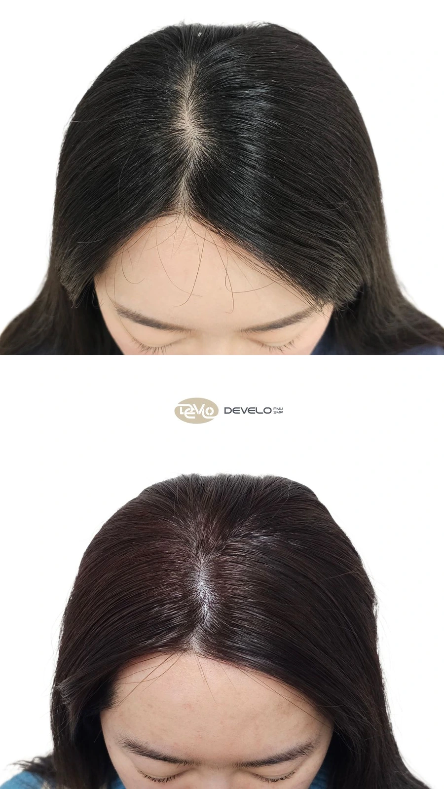 헤어라인 시술 전후 비교 사례